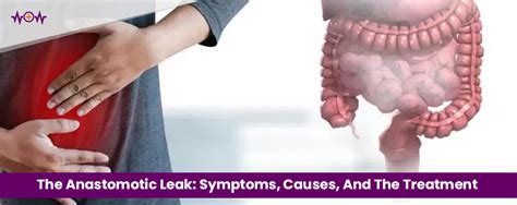 asssthetic leak|Anastomotic Leak: Symptoms, Treatment & What It Is